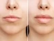 Филъри за устни: Всичко, което трябва да знаете за процедурата